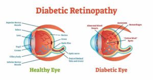 Diabetic Retinopathy Treatment Stafford