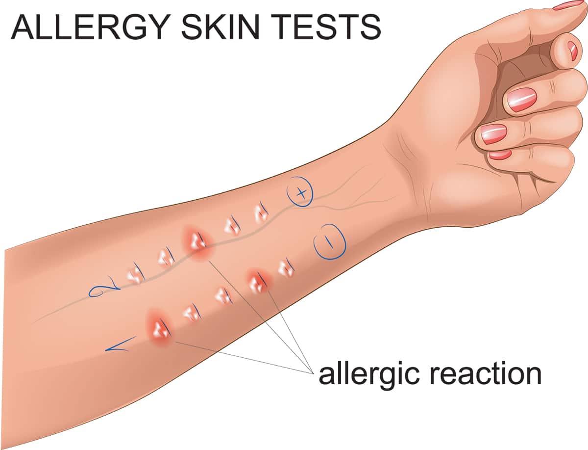 Skin scratch allergy test Fredericksburg