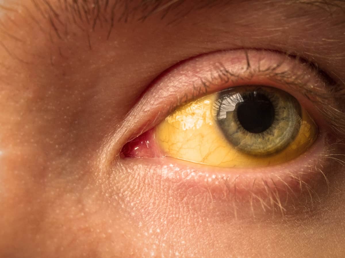 What Causes Yellow Eyes? - Access Eye