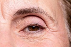 Eyelid Surgery in Falmouth, VA